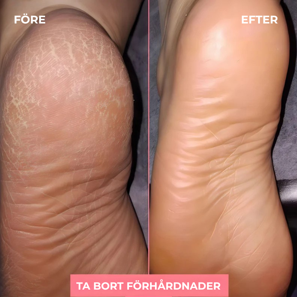 SilkHeel™ – Lena Hälar på Bara Några Minuter