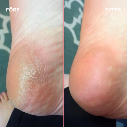 SilkHeel™ – Lena Hälar på Bara Några Minuter