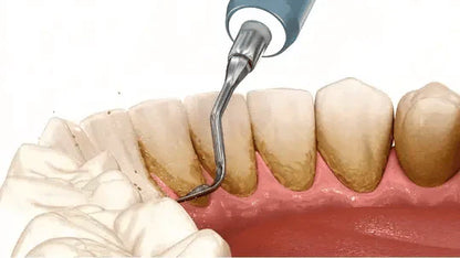 SmilePro™ – Ta Bort Tandsten & Plack Hemma